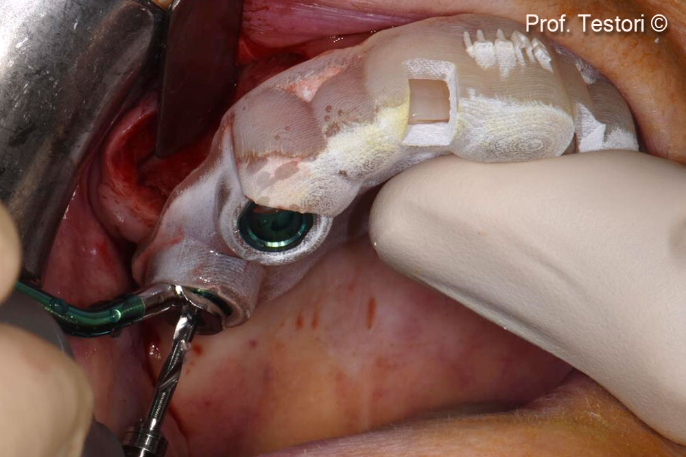 Implant site preparation.