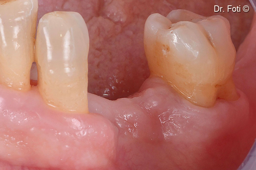 The pre-operative clinical image shows a lack of teeth in positions 34 and 35.