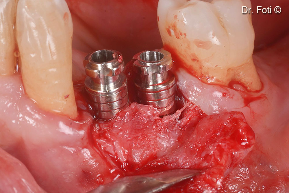Two healing abutments are placed six months after the surgery