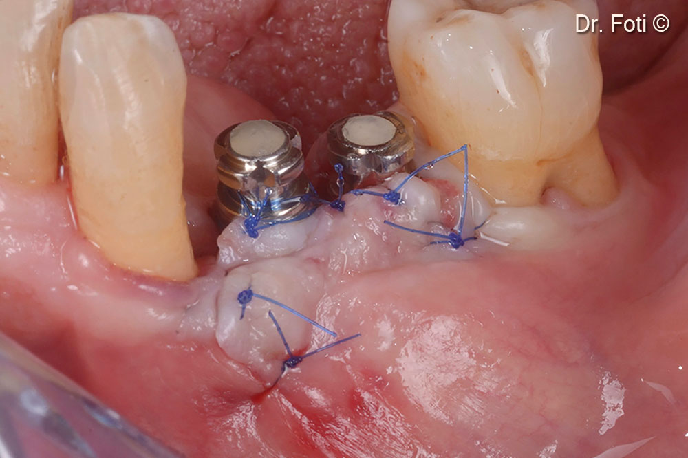 5/0 monofilament sutures sling around the healing abutments.