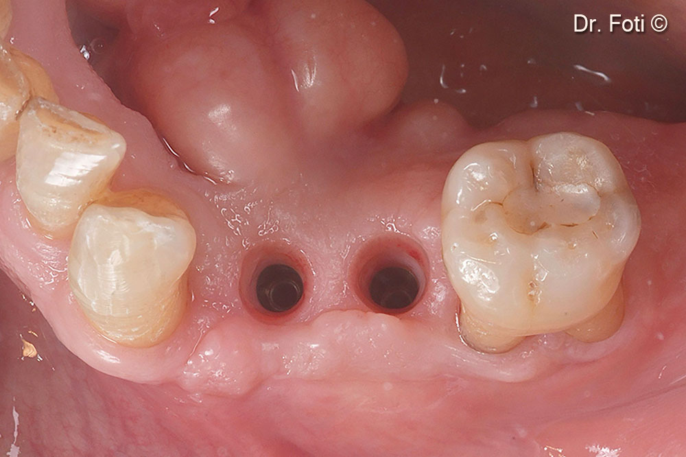 The clinical view shows the complete and uneventful soft
