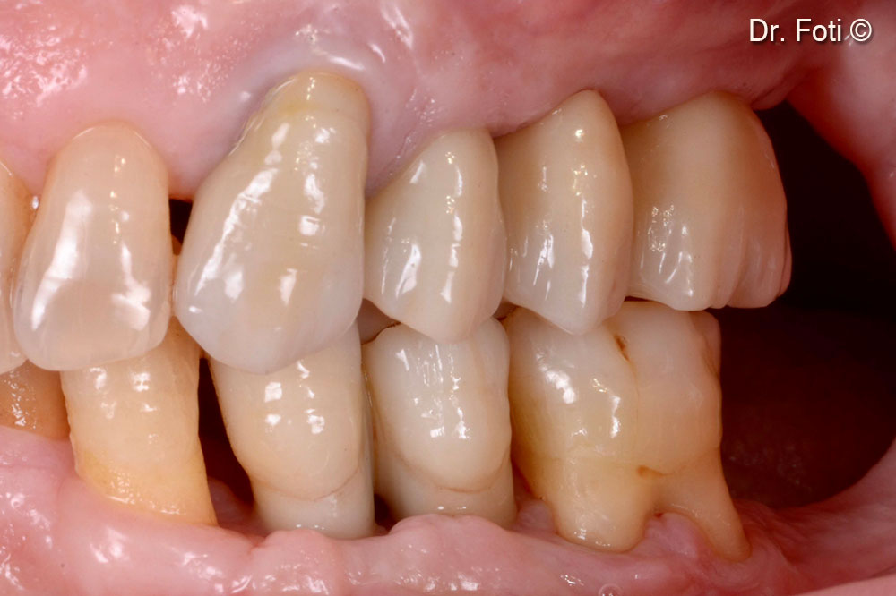 Prosthetic rehabilitation using a screwed monolithic zirconium bridge. Papillae are absent, but there is adequate keratinised mucosa