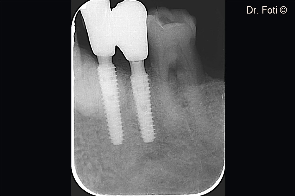 The follow-up radiograph shows newly formed bone between the canine and implant in position 34