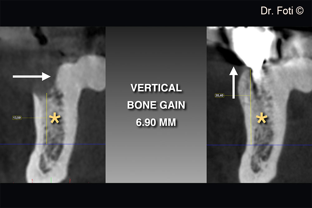 The two-year follow-up CBCT shows a vertical bone gain of 6.90 mm