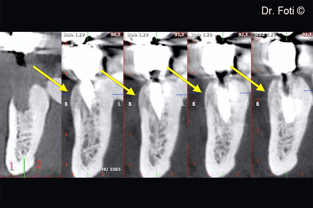 CBCT cross sections at 2 years show the presence of a convex-shaped porcine cortical lamina (arrows). Long-term resorption of the cortical lamina promotes this type of result.