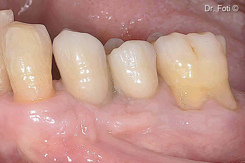 The seven-year follow-up shows creeping of the keratinized mucosa and new papillae formation. The bone peak is stable between the canine and the implant in position 34