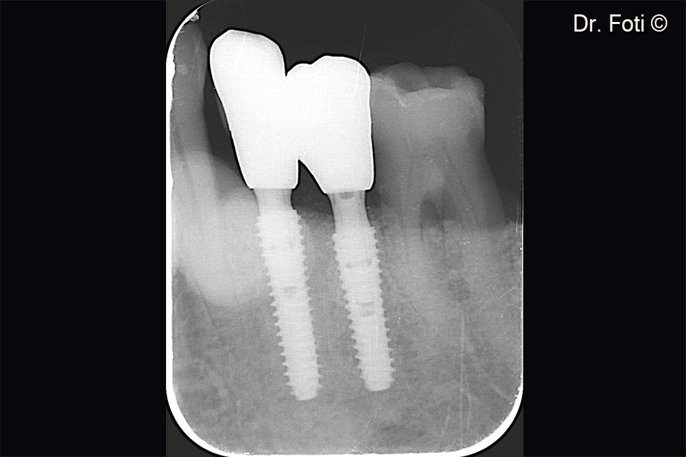The seven-year follow-up shows creeping of the keratinized mucosa and new papillae formation. The bone peak is stable between the canine and the implant in position 34