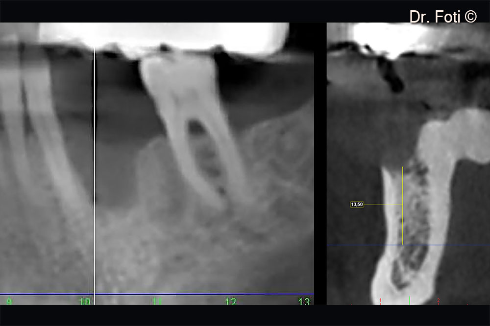 The CBCT scan revealed a vertical defect in position 34