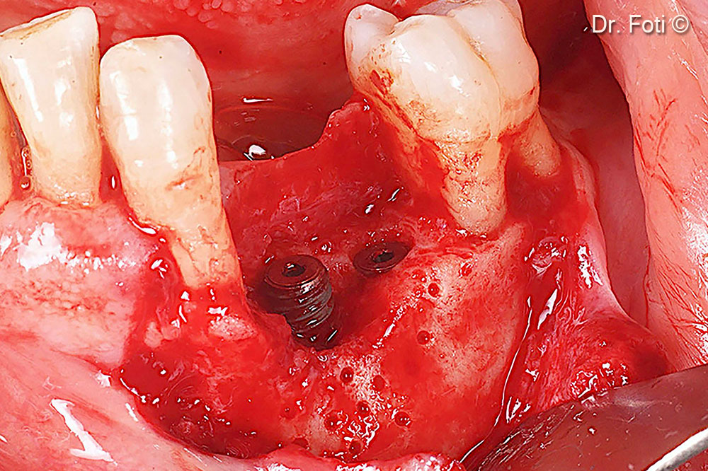 Two implants are placed. The cortical bone is drilled to promote bleeding and recruit Mesenchymal Stem Cells