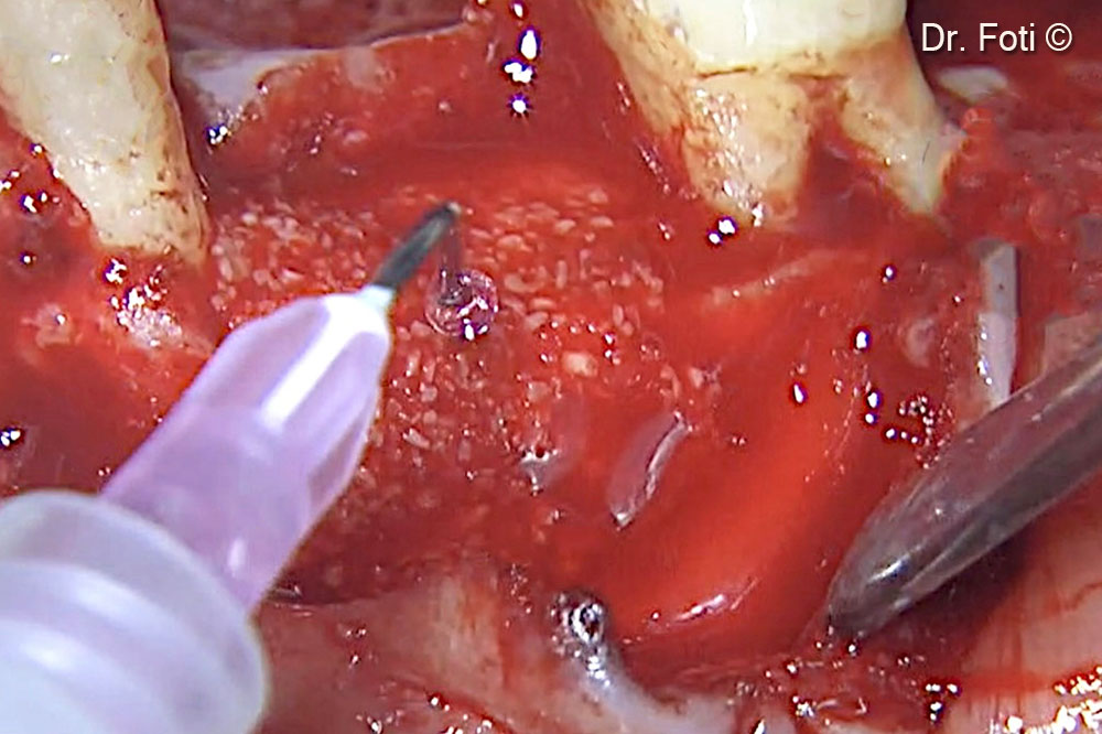 A fibrin sealant, after dilution 1:10 of the thrombin, is mixed with Gen-Os®