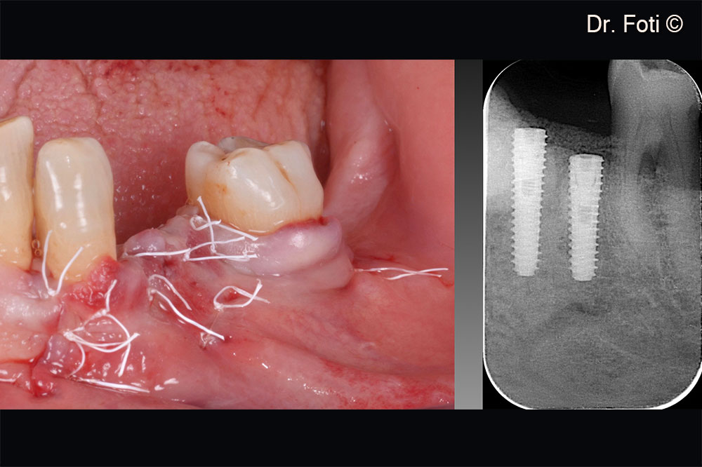 Suture without tension on the edges. Post-operative x-ray.