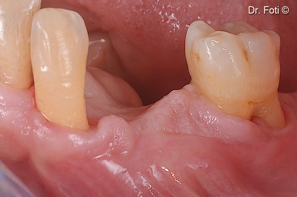 New anatomy and volume of the site after six months.