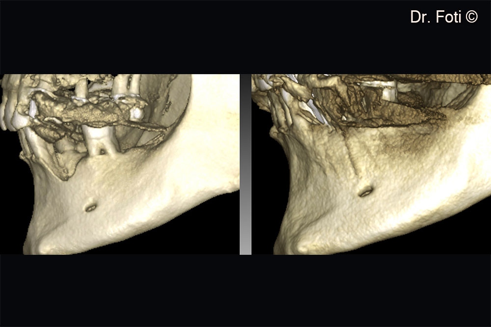 The comparison of the pre-operative and the two-year follow-up. CBCT reveals new bone formation in positions 34 and 35.