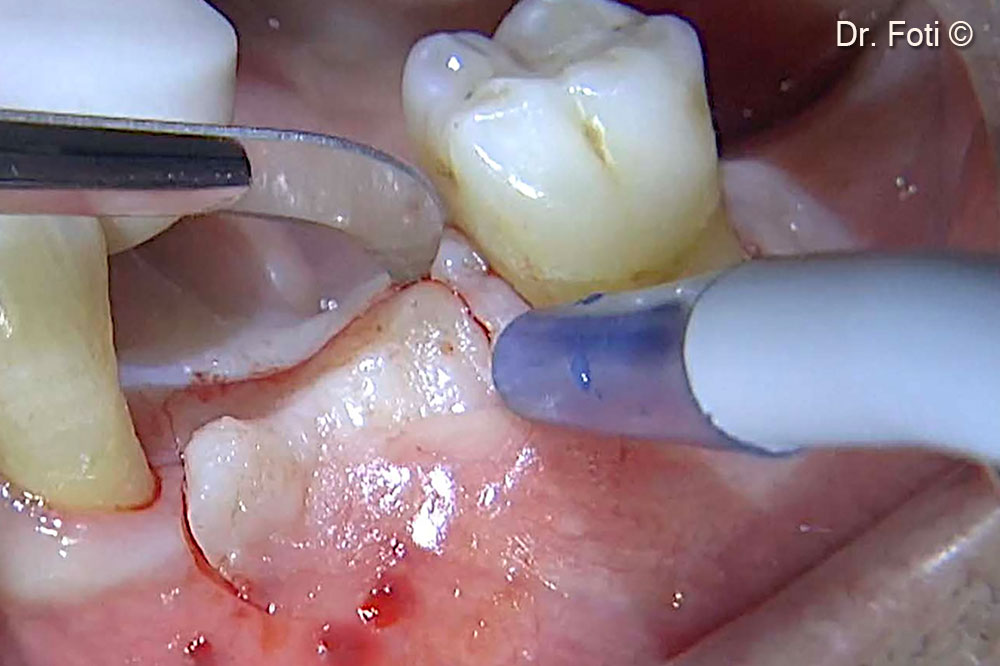 Since, compared to other techniques, there is no need to remove barriers, pins, or screws, a minimally invasive, partial-thickness incision is made to expose the implants.