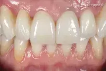 singletooth_cover
