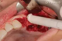 Advancedperiodontaldisease_cover.jpg
