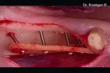 Reconstructionofanatrophicmandible_cover.jpg