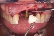 TheIn-BetweenImplant_cover.jpg