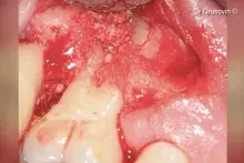 Treatmentofuppermolarfurcation_cover.jpg