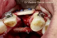 Verticalandhorizontalboneaugmentation_cover.jpg