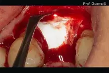 Gen-Os is used to reconstruct the missing bone around an implant