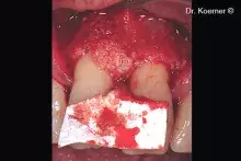 Evolution and mp3 are used to treat a periodontal defect