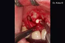 Gel 40 is used to treat a periodontal defect
