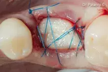 Socket sealing with Derma