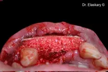Lamina is used to reconstruct the buccal bone