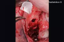 Evolution is used to cover the antrostomy