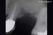 Gel 40 gently displaced the Schneiderian membrane