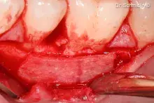 Lamina is uded to reconstruct the missing buccal bone