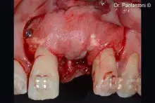 An Evolution collagen membrane is used to stabilise the graft