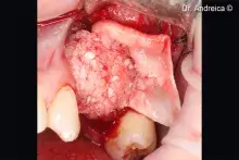 Autogenous bone and mp3 are used to fill the sinus