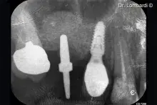 Putty detaches and displaces the sinus membrane