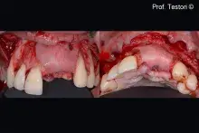 Lamina is used to reconstruct the missing buccal bone