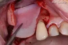 Lamina has been adapted to the anatomy of the defect and placed to reconstruct the missing bony wall