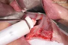 GTO® is placed into the sinus