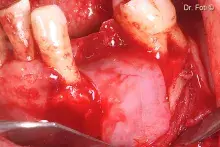 Lamina is glue onto the pristine bone